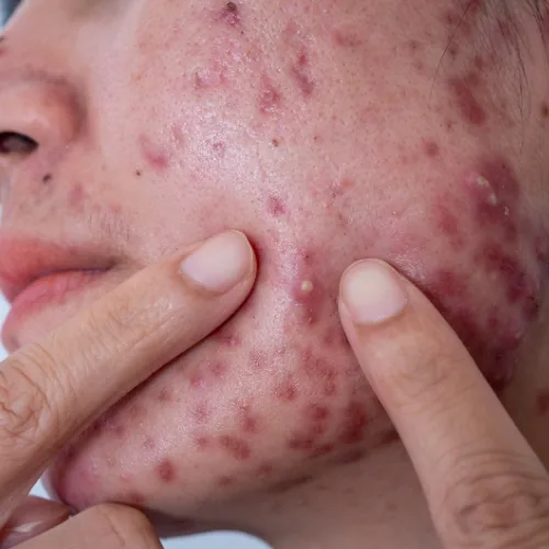 Acne conglobata