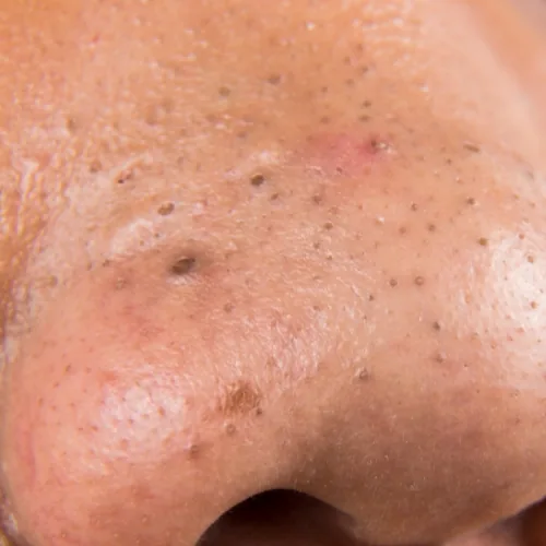 Mee-eters (acne comedonica)