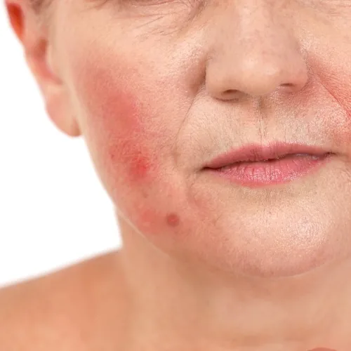Behandeling van roodheid en rosacea in Huidpraktijk Rhoon