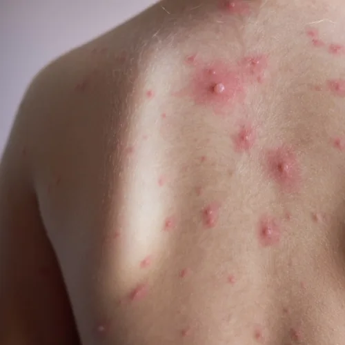 Acne op de rug