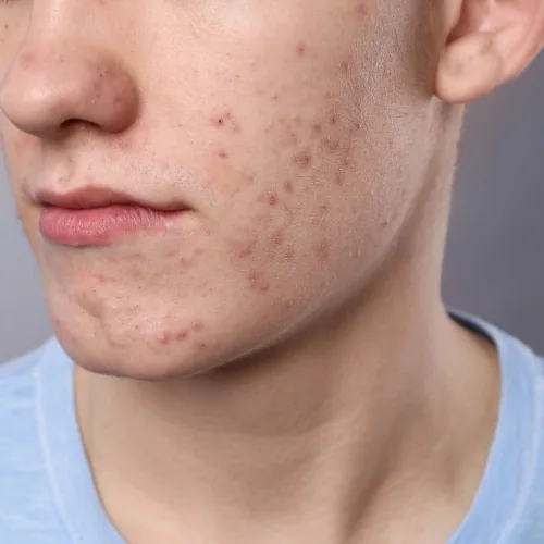Acne vulgaris