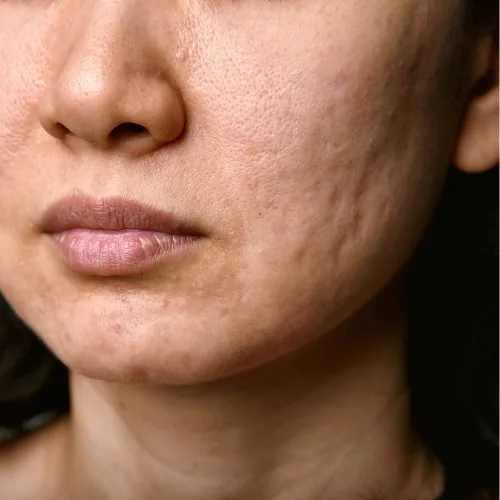 Behandeling van acne littekens in Huidpraktijk Rhoon