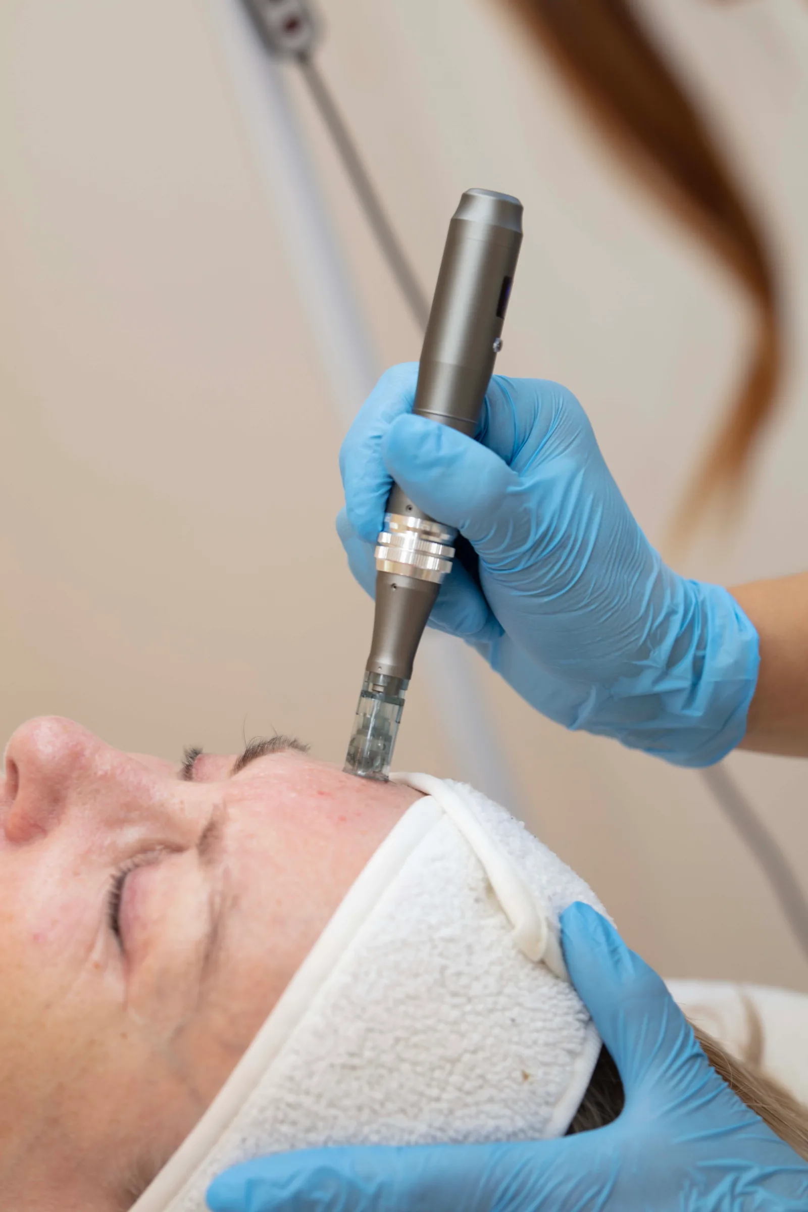 Microneedling
